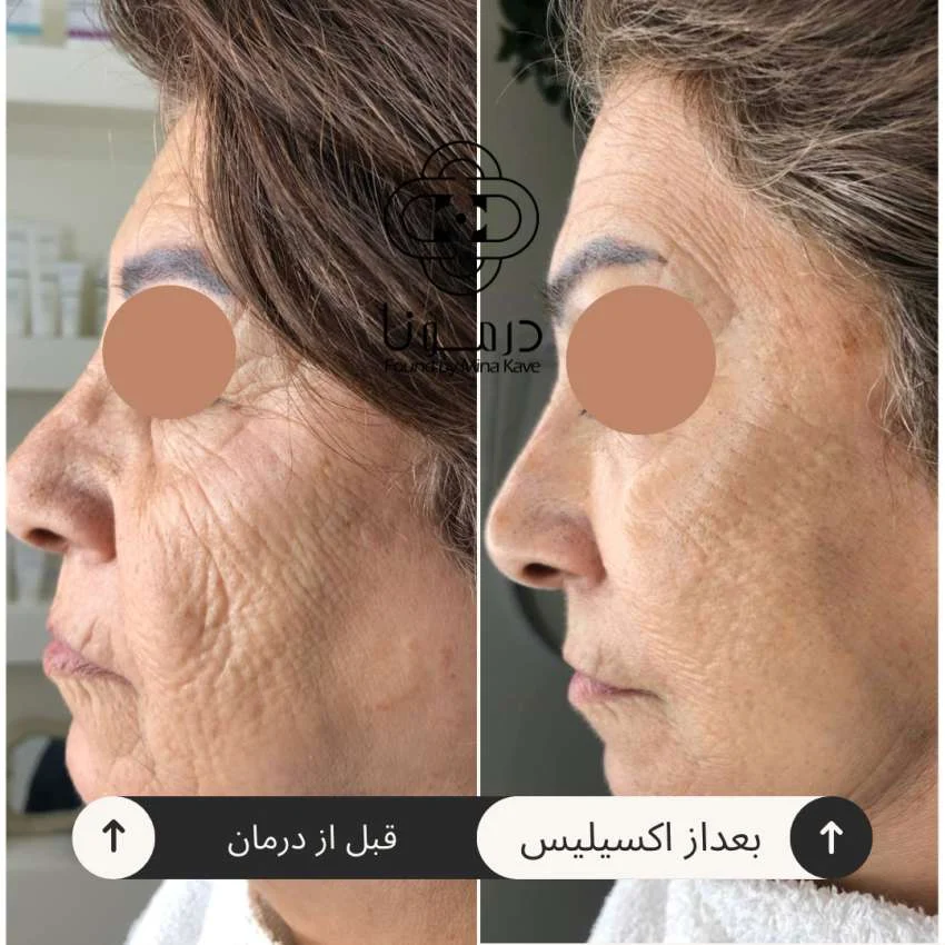 اکسلیس