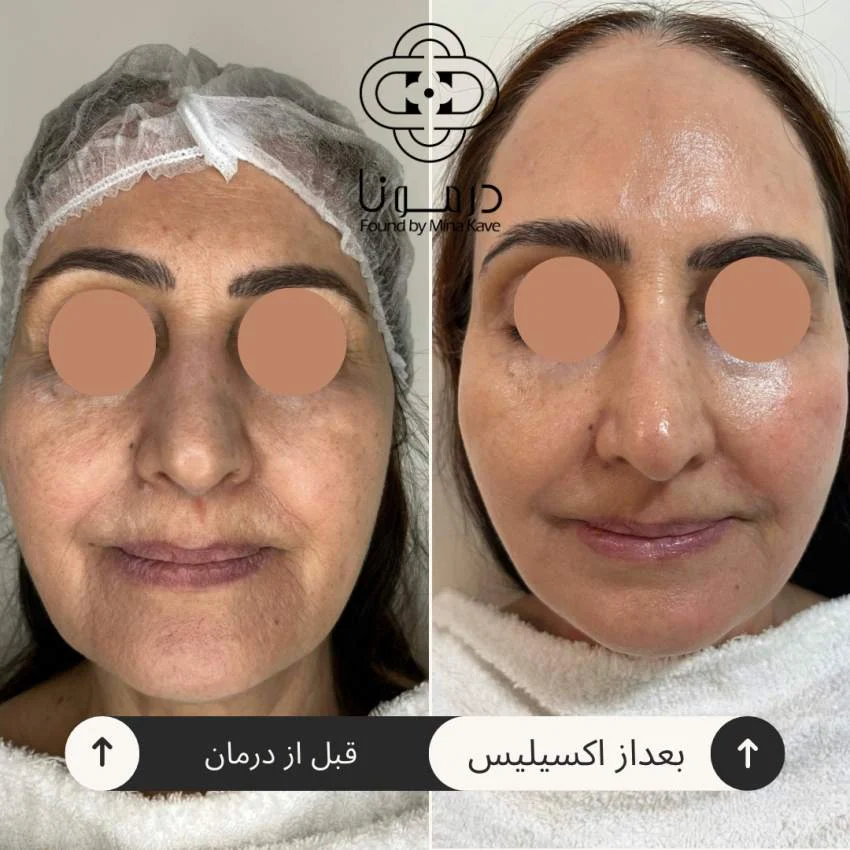 اکسیلیس